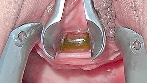 pee hole fucking with toothbrush and insertion of long metal chain into her bladder