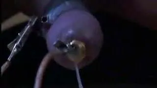CBT - Electrode Insertion Till Cum