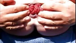 Ass Gape Extreme Monster Extrem Prolapse Asshole