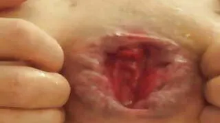 Anal games prolapse stretching ass gape arse insertion 